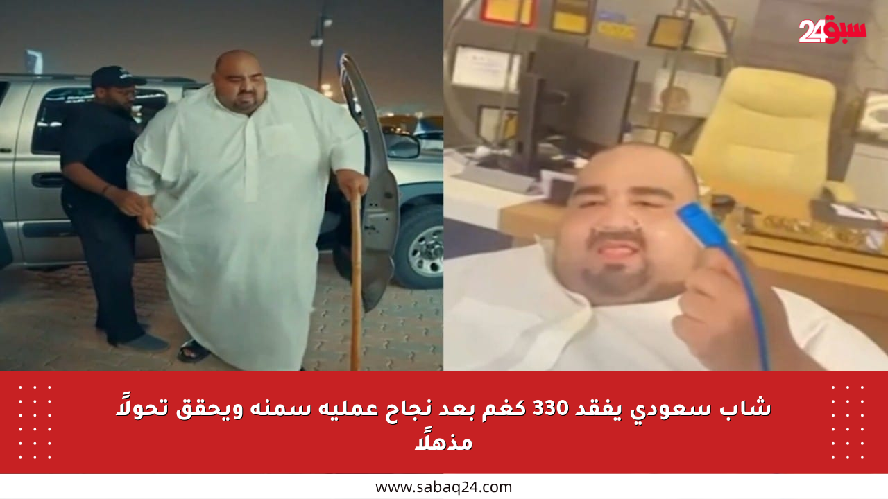 شاب سعودي يفقد 330 كغم بعد نجاح عملية سمنة ويحقق تحولًا مذهلًا
